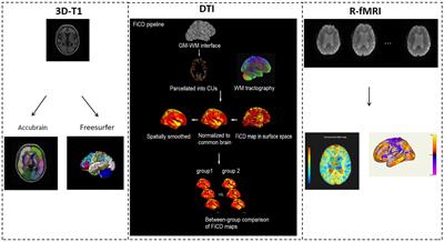 Neuroimaging anomalies in asymptomatic middle cerebral artery steno-occlusive disease with normal-appearing white matter